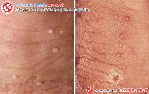 sùi mào gà giai đoạn đầu