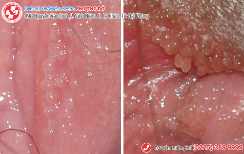 sùi mào gà giai đoạn đầu