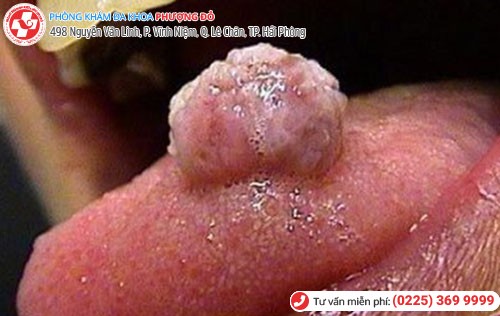 Sùi mào gà ở lưỡi Sùi mào gà ở lưỡi