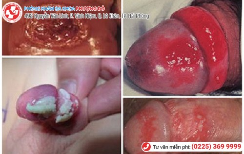 hình ảnh đầu dương vật có mủ