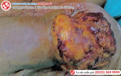 biến chứng sùi mào gà dương vật