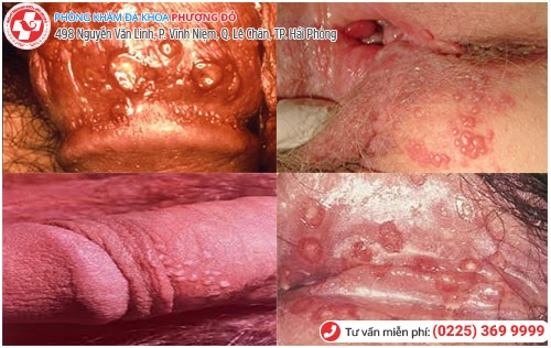biểu hiện mụn rộp sinh dục biểu hiện mụn rộp sinh dục