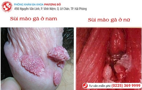 biểu hiện sùi mào gà biểu hiện sùi mào gà