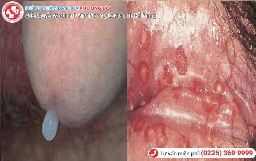 lậu cấp tính