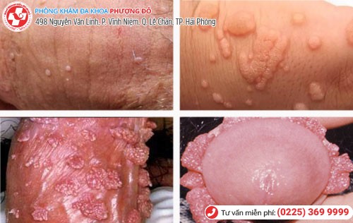 Mọc mụn dương vật là do bệnh sùi mào gà ở nam Nguyên nhân mọc mụn dương vật