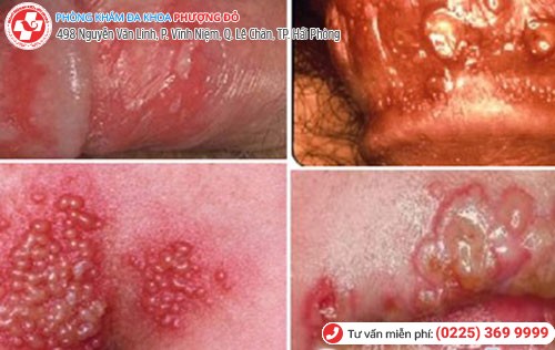 Mụn cóc sinh dục ở nam Mụn cóc sinh dục ở nam