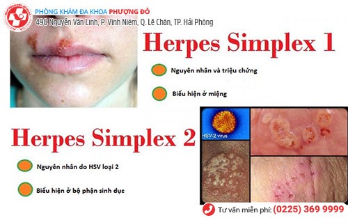 Virus HSV gây mụn rộp sinh dục gồm 2 loại: Type 1 và 2 Virus HSV gây mụn rộp sinh dục gồm 2 loại: Type 1 và 2