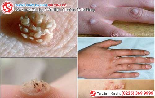 Hình ảnh mụn cơm hoa liễu Hình ảnh mụn cơm hoa liễu