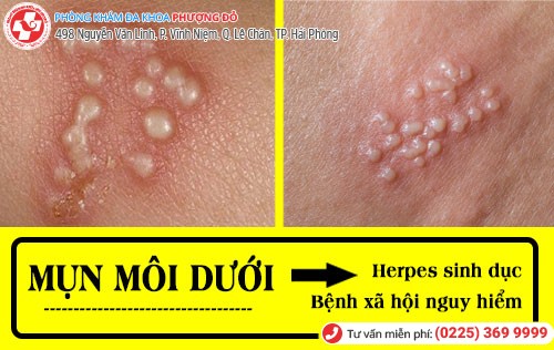 Mụn môi dưới là Herpes sinh dục Mụn môi dưới là herpes sinh dục
