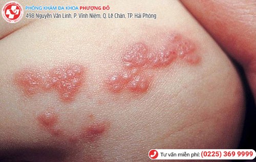 Hình 1 Mụn rộp sinh dục 1