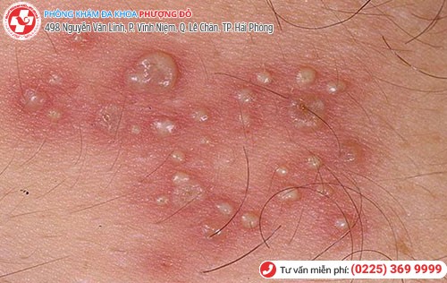 Hình 2 Mụn rộp sinh dục 2