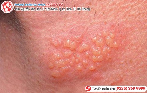 Hình 3 Mụn rộp sinh dục 3