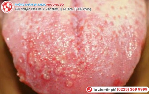 Hình 4 Mụn rộp sinh dục 4