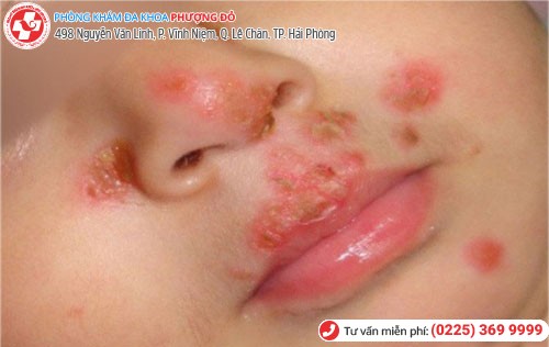 Hình 6 Mụn rộp sinh dục 6