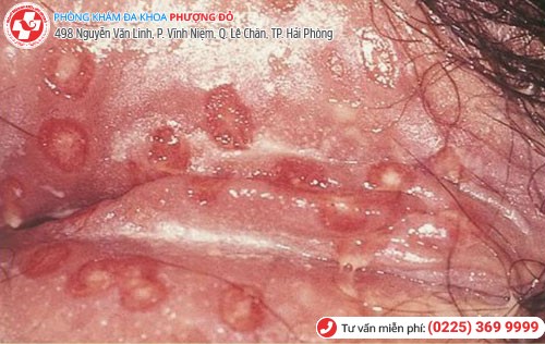 Hình 7 Mụn rộp sinh dục 7