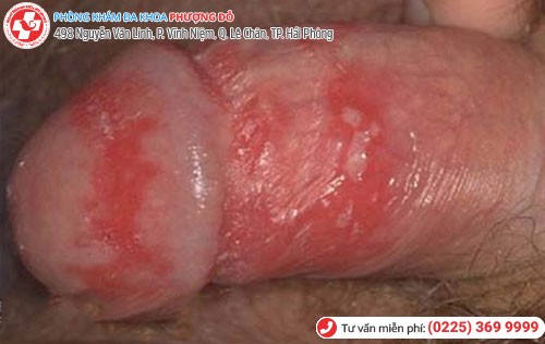 Hình 8 Mụn rộp sinh dục 8