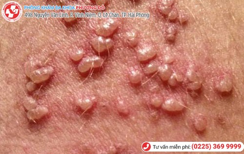 Hình ảnh mụn rộp sinh dục giai đoạn đầu Hình ảnh mụn rộp sinh dục giai đoạn đầu