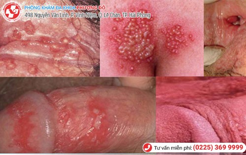 Hình ảnh mụn rộp ở nam Hình ảnh mụn rộp ở nam