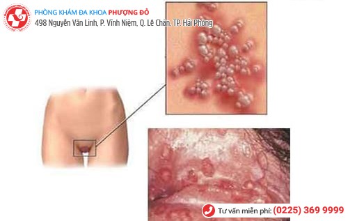 biểu hiện mụn rộp sinh dục nữ
