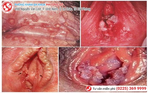 Hình ảnh mụn rộp sinh dục ở nữ Hình ảnh mụn rộp sinh dục ở nữ