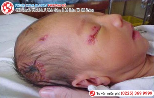 mụn rộp sinh dục ở trẻ
