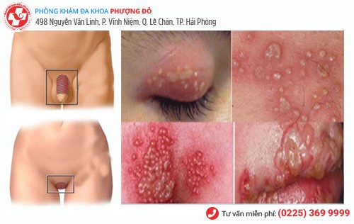 Mụn rộp sinh dục xuất hiện nhiều vị trí Mụn rộp sinh dục xuất hiện nhiều vị trí
