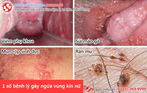ngứa bộ phận sinh dục nữ