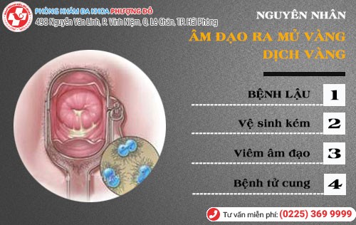 Nguyên nhân âm đạo ra mủ vàng, dịch vàng Nguyên nhân âm đạo ra mủ vàng, âm đạo ra dịch vàng
