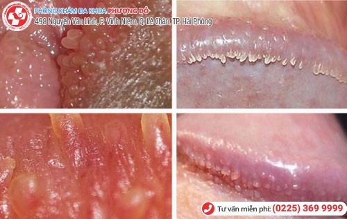 U nhú sinh dục có thể là bệnh sùi mào gà Nguyên nhân u nhú sinh dục