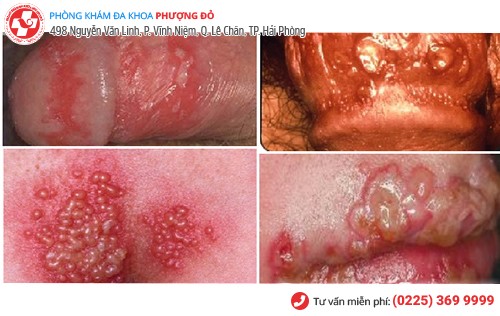 Mụn rộp ở nam giới Mụn rộp ở nam giới