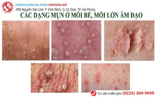 nổi mụn môi lớn môi bé