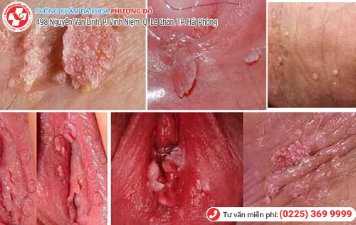 Môi lớn môi bé nổi mụn do nhiều bệnh gây nên Môi lớn môi bé nổi mụn do nhiều bệnh gây nên