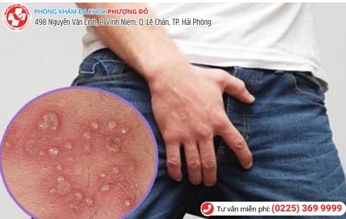 Mụn ở háng nam do nhiều nguyên nhân gây nên Mụn ở háng nam do nhiều nguyên nhân gây nên