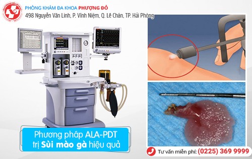 Sùi mào gà nữ Sùi mào gà nữ