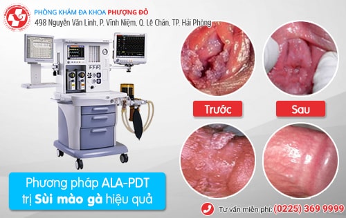 Các giai đoạn sùi mào gà