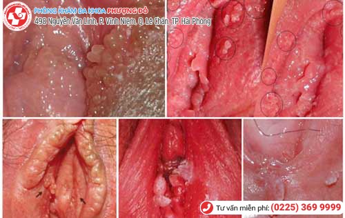 hình ảnh sùi mào gà âm đạo