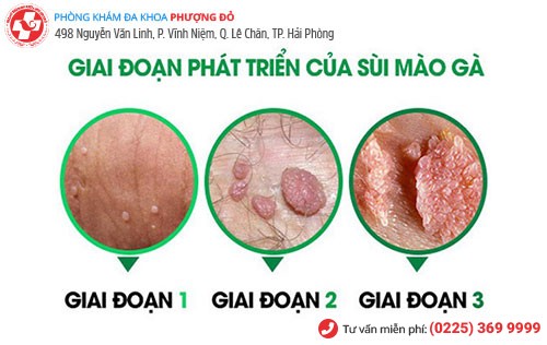 Các giai đoạn phát triển sùi mào gà