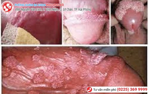 Bệnh sùi mào gà Bệnh sùi mào gà