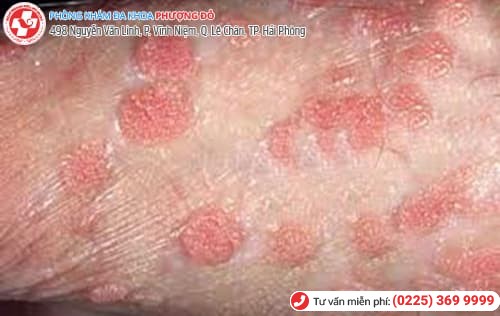 sùi mào gà nguyên phát