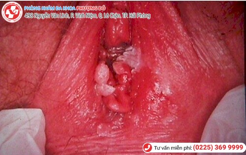 sùi mào gà âm đạo