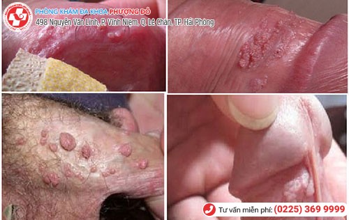 Sùi mào gà ở cơ quan sinh dục nam