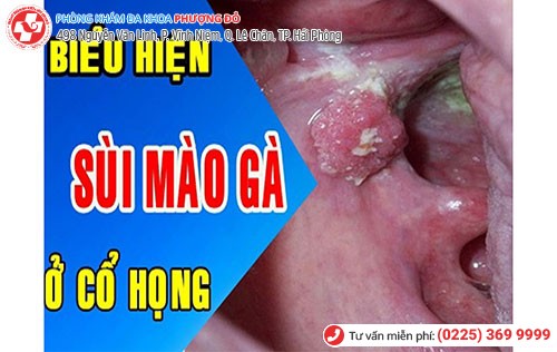 Hình ảnh sùi mào gà ở họng Hình ảnh sùi mào gà ở họng