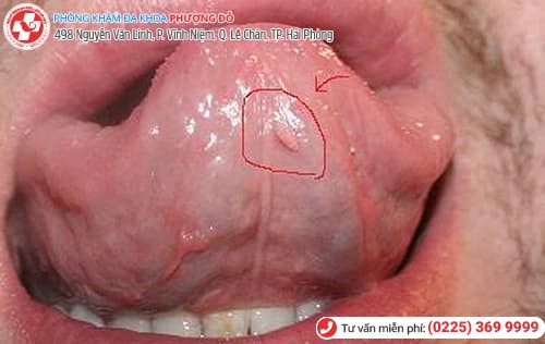 sùi mào gà ở lưỡi