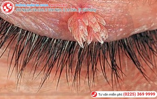 hình ảnh sùi mào gà ở mắt