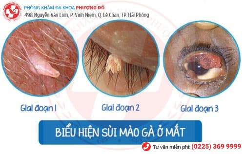 sùi mào gà ở mắt sùi mào gà ở mắt