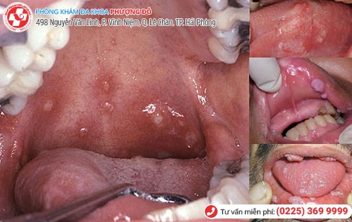 Hình ảnh sùi mào gà ở miệng Hình ảnh sùi mào gà ở miệng