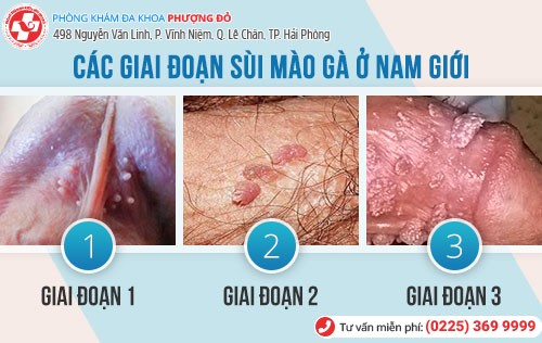 biểu hiện sùi mào gà ở nam