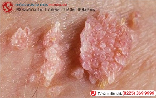 Cận cảnh các nốt sùi mào gà ở nam Sùi mào gà ở nam