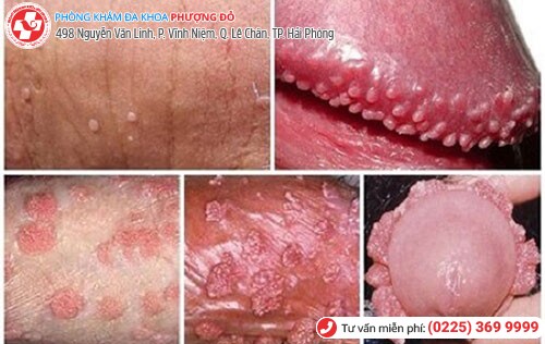 Hình ảnh sùi mào gà ở nam giới Hình ảnh sùi mào gà ở nam giới