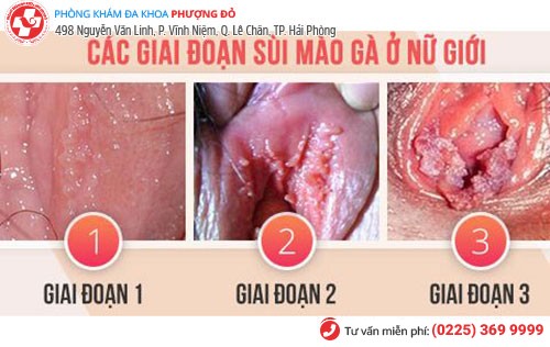 Hình ảnh sùi mào gà ở nữ Hình ảnh sùi mào gà ở nữ